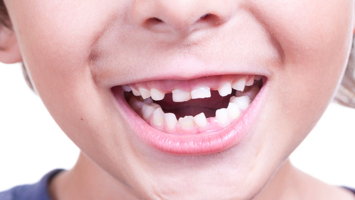 Что делать, если у ребенка криво растут зубы?